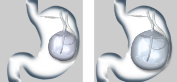 ballon_ajustable_ajustement_volume