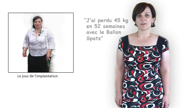ballon_ajustable_temoignage01
