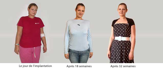 ballon_ajustable_temoignage02